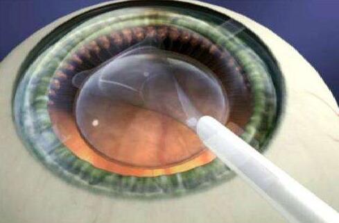 ICL晶体植入术.jpg ICL晶体植入术.jpg