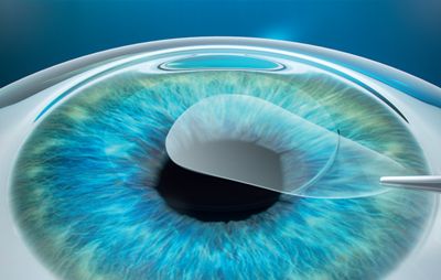 近视手术哪一种好.jpg 近视手术哪一种好.jpg