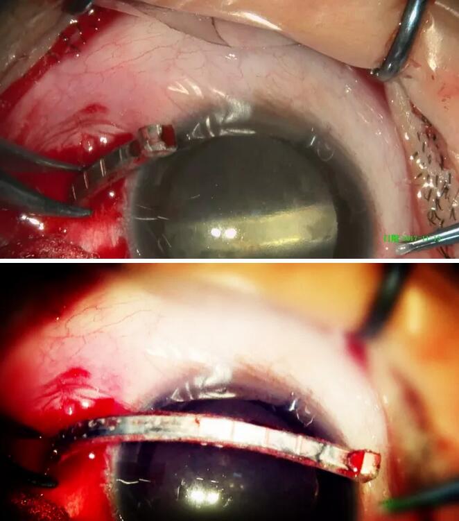 11月14日,东莞太阳成tyc7111cc一天完成两 因装修导致眼外伤病 ,让两位患者,两个家庭悬着的心终于放下了。2.jpg