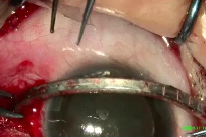 11月14日,东莞太阳成tyc7111cc一天完成两 因装修导致眼外伤病 ,让两位患者,两个家庭悬着的心终于放下了。4.jpg