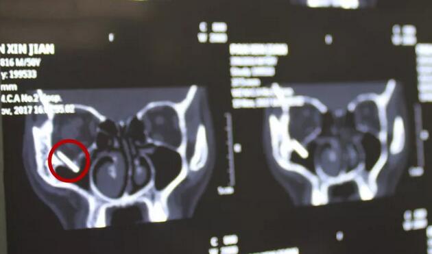 当地的医生跟我说,如果做手术他们只有50%的把握能把我爸眼睛里的东西取出来,而且还不知道会不会伤到眼睛其他部位,我实在是不放心。”刘先生的儿子回忆道。孝顺的儿子不想让爸爸的眼睛承受“50%失败的可能性”,在经过多方打听后,知道福州眼科医院副院长、眼眶病科李谦益主任是这方面的“好手”,他决定带着爸爸到福州寻找 .jpg 当地的医生跟我说,如果做手术他们只有50%的把握能把我爸眼睛里的东西取出来,而且还不知道会不会伤到眼睛其他部位,我实在是不放心。”刘先生的儿子回忆道。孝顺的儿子不想让爸爸的眼睛承受“50%失败的可能性”,在经过多方打听后,知道福州眼科医院副院长、眼眶病科李谦益主任是这方面的“好手”,他决定带着爸爸到福州寻找 .jpg