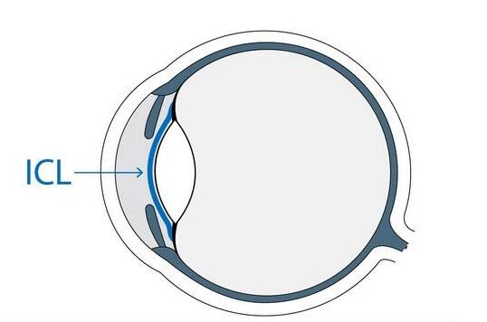 ICL晶体植入术.jpg ICL晶体植入术.jpg