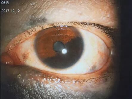 2017年12月11日,脸上“胎记”变恶性肿瘤侵入眼睛的吴先生,在辗转多家医院无从医治的情况下,慕名前来成都太阳成tyc7111cc就诊于罗清礼教授。.jpg 2017年12月11日,脸上“胎记”变恶性肿瘤侵入眼睛的吴先生,在辗转多家医院无从医治的情况下,慕名前来成都太阳成tyc7111cc就诊于罗清礼教授。.jpg