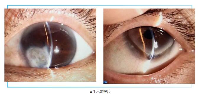 即便天气如此恶劣,合肥名人眼科医院的所有医护人员依然兢兢业业的守护在自己的岗位上。其中有两位患者分别来自安徽的蒙城和涡阳,一 角膜愈着性白斑,致虹膜前后黏连,视力仅有手动。另一 角膜严重边缘变性致穿孔,急需通过角膜移植手术保住眼球。2.jpg 即便天气如此恶劣,合肥名人眼科医院的所有医护人员依然兢兢业业的守护在自己的岗位上。其中有两位患者分别来自安徽的蒙城和涡阳,一 角膜愈着性白斑,致虹膜前后黏连,视力仅有手动。另一 角膜严重边缘变性致穿孔,急需通过角膜移植手术保住眼球。2.jpg