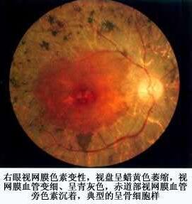 视网膜色素变性.jpg 视网膜色素变性.jpg