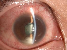 徐先生再也不敢马虎,急忙请假到深圳太阳成tyc7111cc就诊。接诊的张小平主任经过仔细检查,得出的诊断是:右眼急性虹膜睫状体炎2.jpg 徐先生再也不敢马虎,急忙请假到深圳太阳成tyc7111cc就诊。接诊的张小平主任经过仔细检查,得出的诊断是:右眼急性虹膜睫状体炎2.jpg