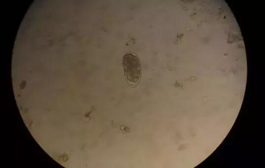 近日合肥名人眼科医院接诊了一位患者,眼睛干涩伴随发痒,同时分泌物较多。医生用显微镜一检查,发现在他睫毛根部长满了一条条蠕动的螨虫!2.jpg 近日合肥名人眼科医院接诊了一位患者,眼睛干涩伴随发痒,同时分泌物较多。医生用显微镜一检查,发现在他睫毛根部长满了一条条蠕动的螨虫!2.jpg