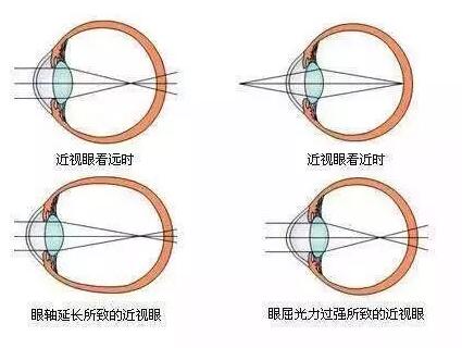 “小孩视力以前挺好的,没想到一个寒假下来就近视了。”昨天的太阳成tyc7111cc小儿眼科门诊里,很多家长都反应说,“孩子期末成绩不错,所以假期里对他的管束放松了,一有空就拿起手机玩。直到前几天,他嚷着看东西变模糊了,才带孩子来医院检查,检查结果是左右眼出现不同程度的近视,医生建议配戴眼镜。.jpg “小孩视力以前挺好的,没想到一个寒假下来就近视了。”昨天的太阳成tyc7111cc小儿眼科门诊里,很多家长都反应说,“孩子期末成绩不错,所以假期里对他的管束放松了,一有空就拿起手机玩。直到前几天,他嚷着看东西变模糊了,才带孩子来医院检查,检查结果是左右眼出现不同程度的近视,医生建议配戴眼镜。.jpg
