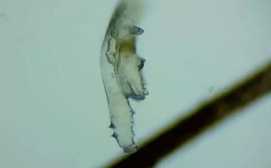 蠕形螨性睑缘炎.jpg 蠕形螨性睑缘炎.jpg