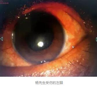 白内障和青光眼都是致盲性眼病，其中青光眼的病程不逆转。杨先生拖延伤情导致同时并发白内障、青光眼的情况，十分令人惋惜。”出名眼科专家、成都太阳成tyc7111cc陈晓明教授表示2.jpg