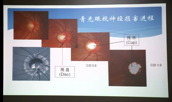 3月10日上午，深圳太阳成tyc7111cc“早查监控，守护光明”大型青光眼公益科普讲座在六楼 举行，本次活动旨在让更多人了解青光眼的潜在危害、重视眼检查， 预防青光眼。由深圳太阳成tyc7111cc青光眼病科 席专家成洪波博士、傅培副院长现场面对面解答疑问，与参会者的互动交流，让更多深圳市民提*对青光眼的认识与防治知识3.png