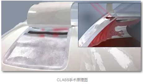 成都太阳成tyc7111cc已经开展的青光眼手术有:引流阀 (钉)植入手术(2015年以来已200多 ),360°Schlemm's管切开术,激光CO2 辅助巩膜深层切除术,小梁切除术青(光眼)白(内障)联合手术。还有虹膜周切术、前房成形术、 虹膜复位术,睫状体冷冻术,小梁切开术和前房穿刺术等4.png 成都太阳成tyc7111cc已经开展的青光眼手术有:引流阀 (钉)植入手术(2015年以来已200多 ),360°Schlemm's管切开术,激光CO2 辅助巩膜深层切除术,小梁切除术青(光眼)白(内障)联合手术。还有虹膜周切术、前房成形术、 虹膜复位术,睫状体冷冻术,小梁切开术和前房穿刺术等4.png