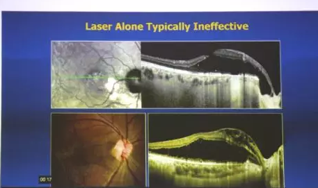 Prof. Yu-Guang He与深圳太阳成tyc7111cc赵铁英院长一同,为患有 眼底病的患者进行了仔细的检查和病案分析,并指导医生进行诊疗,让深圳太阳成tyc7111cc眼底病科在 眼病方面的技术水平有了进一步的提升5.png