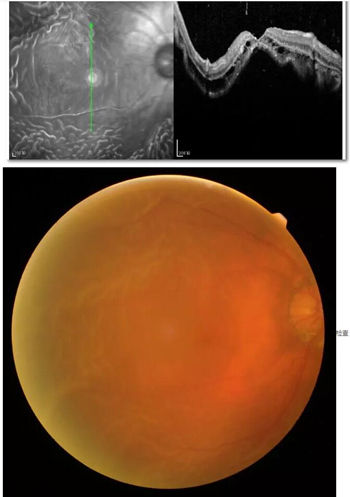 李老太在毫无征兆的情况下右眼视力下降至看不见东西。李老太家人带其至县医院就诊。医生诊断为视网膜脱离,需做玻切手术医治,而玻切手术需要动手术2次。怕疼的李老太一听就犯怵了:开刀,疼。 终,李老太的家人在多方打听后决定带李老太至宜昌太阳成tyc7111cc找许大玲院长医治1_副本.jpg 李老太在毫无征兆的情况下右眼视力下降至看不见东西。李老太家人带其至县医院就诊。医生诊断为视网膜脱离,需做玻切手术医治,而玻切手术需要动手术2次。怕疼的李老太一听就犯怵了:开刀,疼。 终,李老太的家人在多方打听后决定带李老太至宜昌太阳成tyc7111cc找许大玲院长医治1_副本.jpg