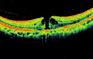 老年人随着年龄增长,黄斑区血管产生异常,黄斑出血、渗出,就损害了视功能,这是很常见的致盲性老年眼病。强烈撞击到眼睛等也会造成黄斑损害或裂孔;由于高度近视造成黄斑裂孔或劈裂等引起严重影响视功能的黄斑病变等。1.jpg 老年人随着年龄增长,黄斑区血管产生异常,黄斑出血、渗出,就损害了视功能,这是很常见的致盲性老年眼病。强烈撞击到眼睛等也会造成黄斑损害或裂孔;由于高度近视造成黄斑裂孔或劈裂等引起严重影响视功能的黄斑病变等。1.jpg