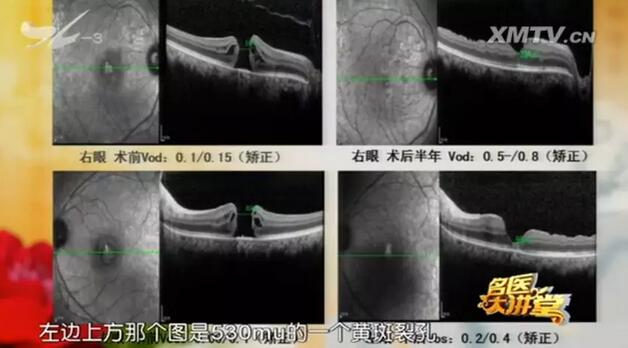 黄斑裂孔是一种常见的黄斑病,是黄斑部视网膜内界膜至感光细胞层发生的组织缺损所引起的。黄斑区位于眼睛视网膜中央,它是视力 敏感区,负责视觉和色觉的视锥细胞就分布于该区域,因此 累及黄斑部的病变都会引起中心视力的明显下降、视物色暗、变形等3.jpg 黄斑裂孔是一种常见的黄斑病,是黄斑部视网膜内界膜至感光细胞层发生的组织缺损所引起的。黄斑区位于眼睛视网膜中央,它是视力 敏感区,负责视觉和色觉的视锥细胞就分布于该区域,因此 累及黄斑部的病变都会引起中心视力的明显下降、视物色暗、变形等3.jpg