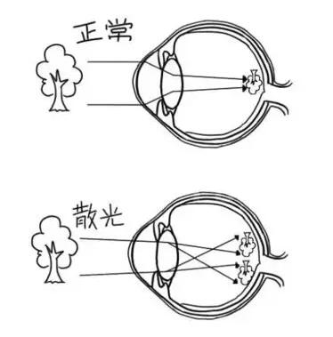 近视加散光想要 ,飞秒全激光近视手术是很好的选择。 一*次近视激光手术,就可以同时 近视、合并散光。1.jpg 近视加散光想要 ,飞秒全激光近视手术是很好的选择。 一*次近视激光手术,就可以同时 近视、合并散光。1.jpg