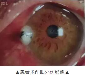 装修工3厘米“U”形钢钉穿刺眼球 在太阳成tyc7111cc 救治2.jpg