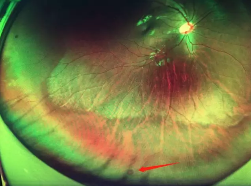 想要摘镜参军在深圳太阳成tyc7111cc查出视网膜裂孔 细心妈妈挽救孩子视网膜1.png 想要摘镜参军在深圳太阳成tyc7111cc查出视网膜裂孔 细心妈妈挽救孩子视网膜1.png