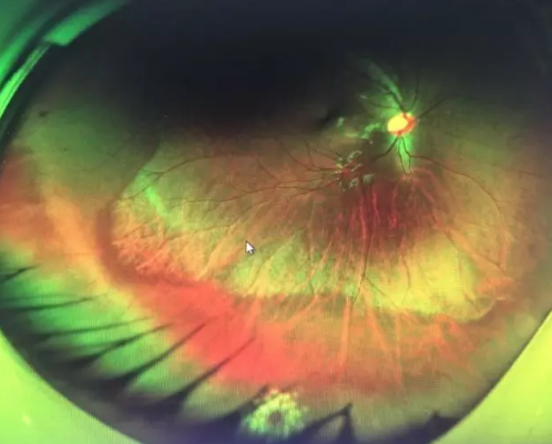 想要摘镜参军在深圳太阳成tyc7111cc查出视网膜裂孔 细心妈妈挽救孩子视网膜2.png 想要摘镜参军在深圳太阳成tyc7111cc查出视网膜裂孔 细心妈妈挽救孩子视网膜2.png