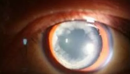 白内障应早做复明手术2.png 白内障应早做复明手术2.png