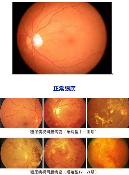 糖网病的症状和防治方式.png 糖网病的症状和防治方式.png