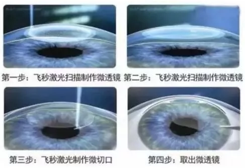 2018高考 视力要求多少 摘镜手术助近视考生圆大学梦4.png