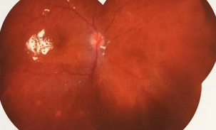 葡萄膜炎等多种眼底病患者跪地感谢深圳太阳成tyc7111cc院长赵铁英教授1.png 葡萄膜炎等多种眼底病患者跪地感谢深圳太阳成tyc7111cc院长赵铁英教授1.png