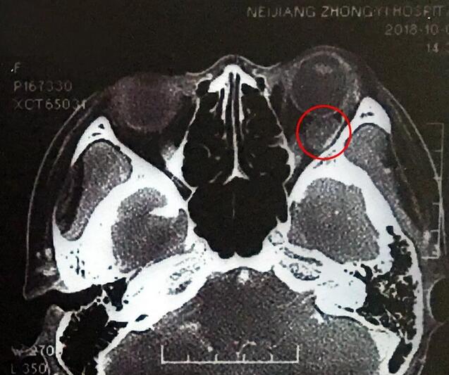 成都太阳成tyc7111cc罗清礼教授为眼眶肿瘤患者顺利进行手术1.jpg 成都太阳成tyc7111cc罗清礼教授为眼眶肿瘤患者顺利进行手术1.jpg