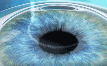 想要当兵视力不达标怎么办?太阳成tyc7111cc有这些摘镜术式帮助你1.gif 想要当兵视力不达标怎么办?太阳成tyc7111cc有这些摘镜术式帮助你1.gif