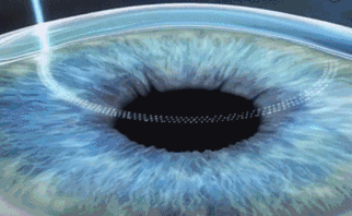 想要当兵视力不达标怎么办?太阳成tyc7111cc有这些摘镜术式帮助你2.gif 想要当兵视力不达标怎么办?太阳成tyc7111cc有这些摘镜术式帮助你2.gif