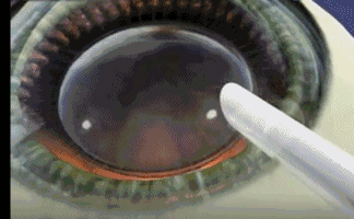 想要当兵视力不达标怎么办?太阳成tyc7111cc有这些摘镜术式帮助你3.gif 想要当兵视力不达标怎么办?太阳成tyc7111cc有这些摘镜术式帮助你3.gif