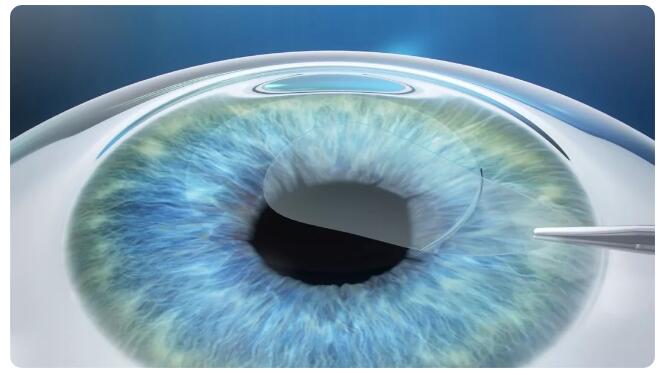 2020年征兵视力要求已出炉,近视青年你们准备好了吗?2.jpg 2020年征兵视力要求已出炉,近视青年你们准备好了吗?2.jpg