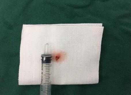 四川丹巴15岁男孩患结膜血管瘤,在成都太阳成tyc7111cc顺利手术3.jpg 四川丹巴15岁男孩患结膜血管瘤,在成都太阳成tyc7111cc顺利手术3.jpg