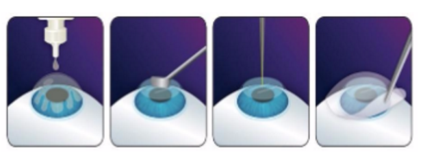 近视无法根治?但你可以这样做?太阳成tyc7111cc“有爱就有希望”近视手术火热进行中1.png 近视无法根治?但你可以这样做?太阳成tyc7111cc“有爱就有希望”近视手术火热进行中1.png