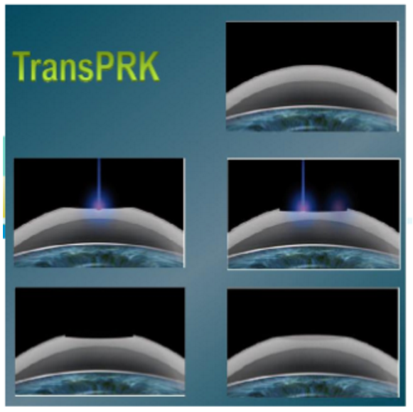 近视无法根治?但你可以这样做?太阳成tyc7111cc“有爱就有希望”近视手术火热进行中3.png 近视无法根治?但你可以这样做?太阳成tyc7111cc“有爱就有希望”近视手术火热进行中3.png