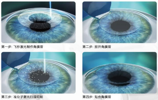 近视无法根治?但你可以这样做?太阳成tyc7111cc“有爱就有希望”近视手术火热进行中5.png 近视无法根治?但你可以这样做?太阳成tyc7111cc“有爱就有希望”近视手术火热进行中5.png