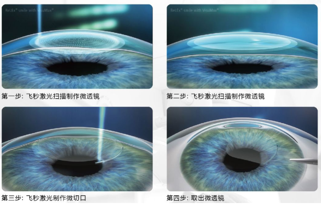 近视无法根治?但你可以这样做?太阳成tyc7111cc“有爱就有希望”近视手术火热进行中6.png 近视无法根治?但你可以这样做?太阳成tyc7111cc“有爱就有希望”近视手术火热进行中6.png