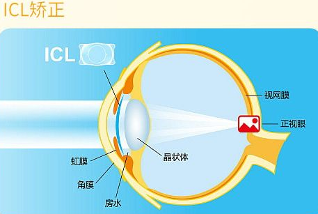 近视无法根治?但你可以这样做?太阳成tyc7111cc“有爱就有希望”近视手术火热进行中8.png 近视无法根治?但你可以这样做?太阳成tyc7111cc“有爱就有希望”近视手术火热进行中8.png