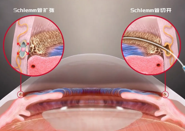厦门眼科中心刘旭阳教授团队青光眼诊疗领域科研成果再登环球学术舞台2.png 厦门眼科中心刘旭阳教授团队青光眼诊疗领域科研成果再登环球学术舞台2.png