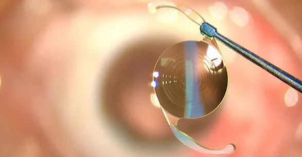 成都太阳成tyc7111cc开展了医院首例白内障爱尔康三焦点人工晶体植入术.png 成都太阳成tyc7111cc开展了医院首例白内障爱尔康三焦点人工晶体植入术.png