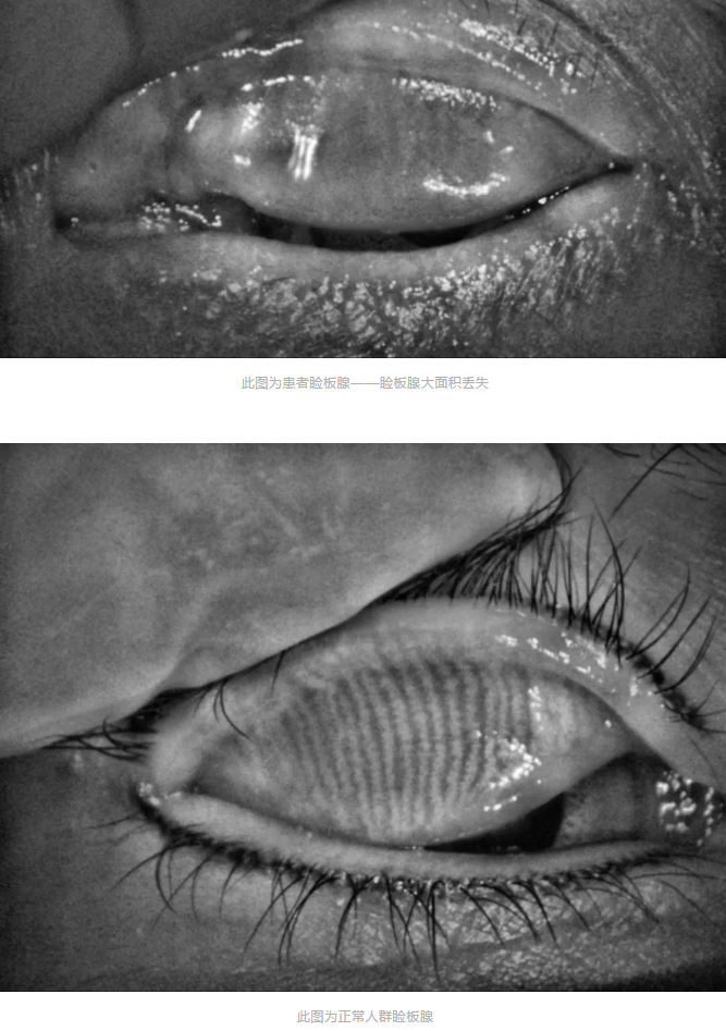 寺院住持来安徽理工大附属眼科医院(淮南太阳成tyc7111cc)做干眼医治3.png 寺院住持来安徽理工大附属眼科医院(淮南太阳成tyc7111cc)做干眼医治3.png