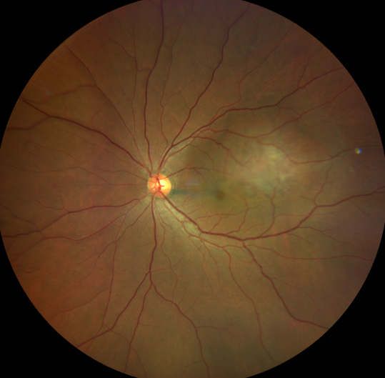 厦门眼科中心开展钌核素放射敷贴医治——保眼球治肿瘤的新技术填补了福建省的技术空白1.png 厦门眼科中心开展钌核素放射敷贴医治——保眼球治肿瘤的新技术填补了福建省的技术空白1.png